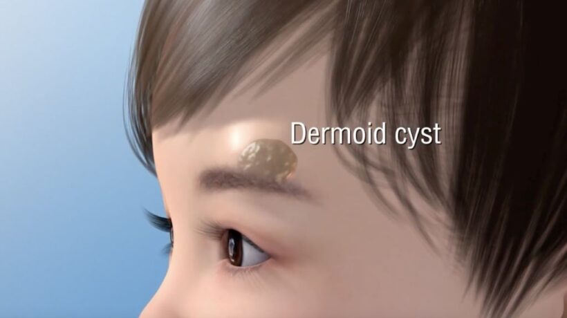 Dermoid Cyst Diagnosis Tips for Beginners